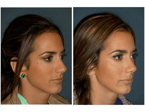 Before & After Gallery - Houston, TX: Houston Sinus Surgery