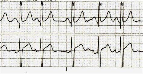 ECG Channel: Sinoatrial Block or Sinoatrial Exit Block