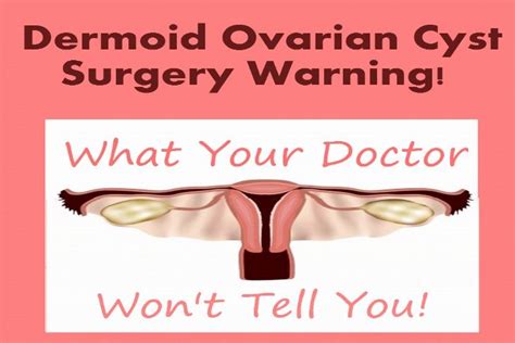 Dermoid Ovarian Cyst Surgery Warning! | Dermoid ovarian cyst, Ovarian cyst surgery, Ovarian cyst