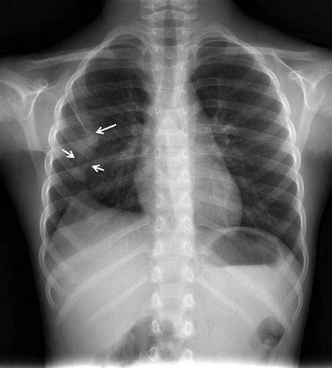 Supernumerary intrathoracic rib | Archives of Disease in Childhood