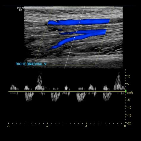 Upper Extremity Venous Doppler – Sonographic Tendencies | Vascular ultrasound, Vascular, Vein ...