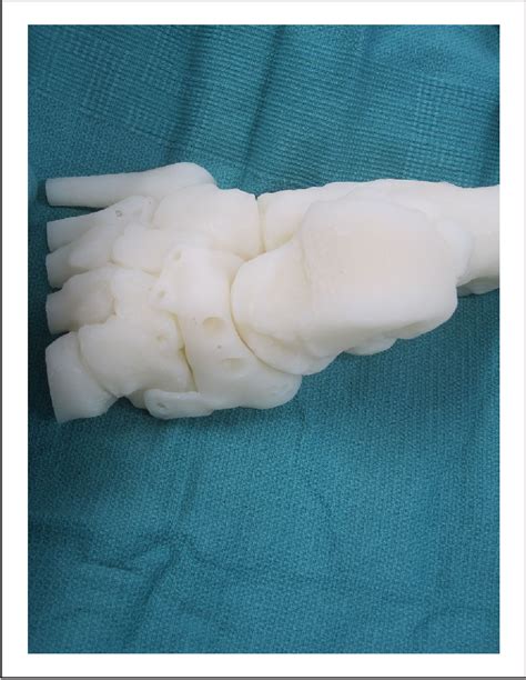Figure 4 from Talonavicular Joint-Sparing 3D Printed Navicular Replacement for Osteonecrosis of ...
