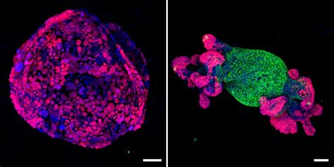 A single gene turns colorectal cancer cells back into normal tissue in ...