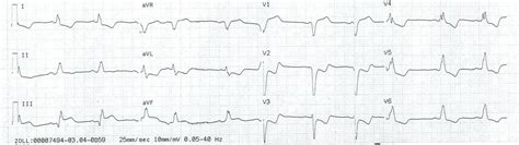 Dr. Smith's ECG Blog: Cardiac arrest, LBBB with STEMI on the ECG, but no Acute Coronary Syndrome!