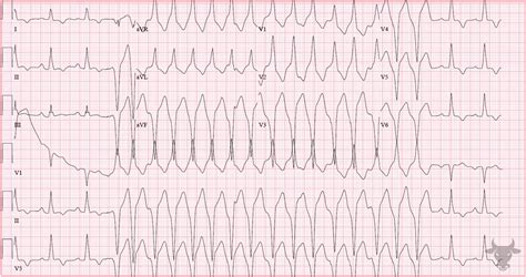 Hypertrophic Cardiomyopathy | ECG Stampede