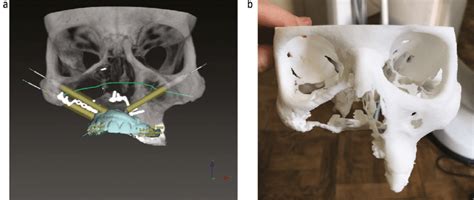 a) Digital planning for three zygomatic implants in relation to the ...