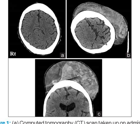 Figure 1 from Life-threatening large subcutaneous hematoma after minor head trauma: A young ...