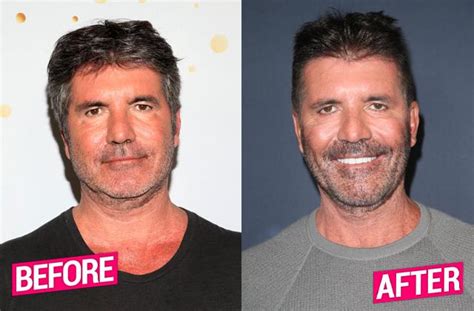 Simon Cowell Plastic Surgery Makeover Exposed By Top Docs