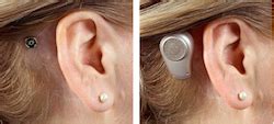 Bone-Anchored Hearing Systems