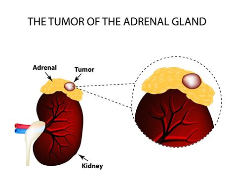 Tumors (functioning & Non-functioning) – GBMC Jordan