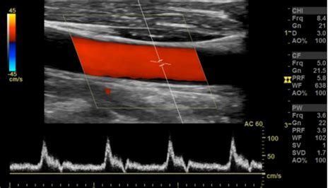 Arterial Doppler/Duplex of the Lower Extremities – Sonographic ...