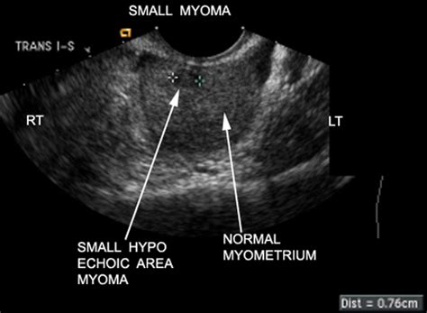 Uterine Fibroids Ultrasound