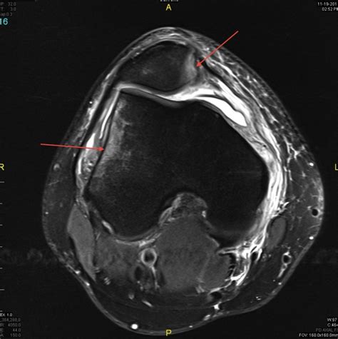 Knee Muscle Anatomy Axial Mri : Magnetic Resonance Imaging Knee Injury ...