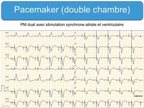 Pacemaker (c) signes ECG : e-cardiogram