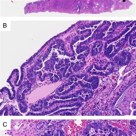 Serous endometrial intraepithelial carcinoma (SEIC) localized to a ...