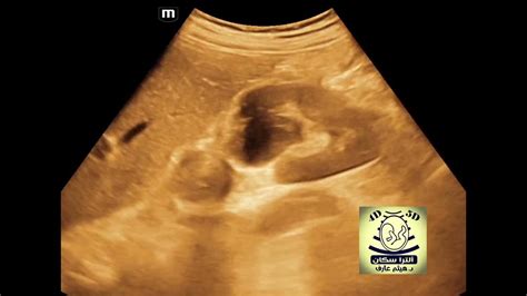 Renal milk of calcium cyst ultrasound - YouTube