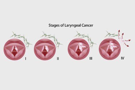 Stages Of Throat Cancer