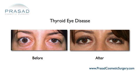 Thyroid Eye Disease Surgery/ Graves Eye Disease Surgery | Dr. Prasad