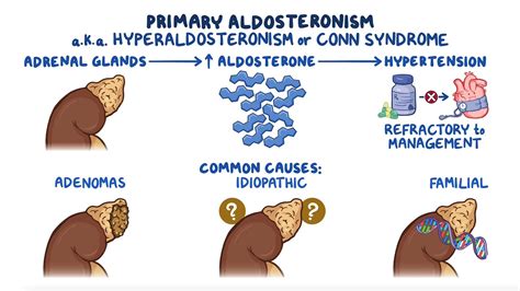 Primary aldosteronism (hyperaldosteronism): Clinical sciences - Osmosis Video Library