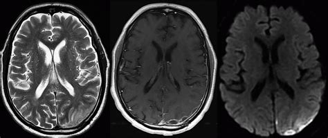 Brain Infections | Radiology Key