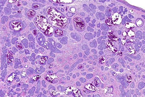 Morpheaform Basal Cell Carcinoma Histology