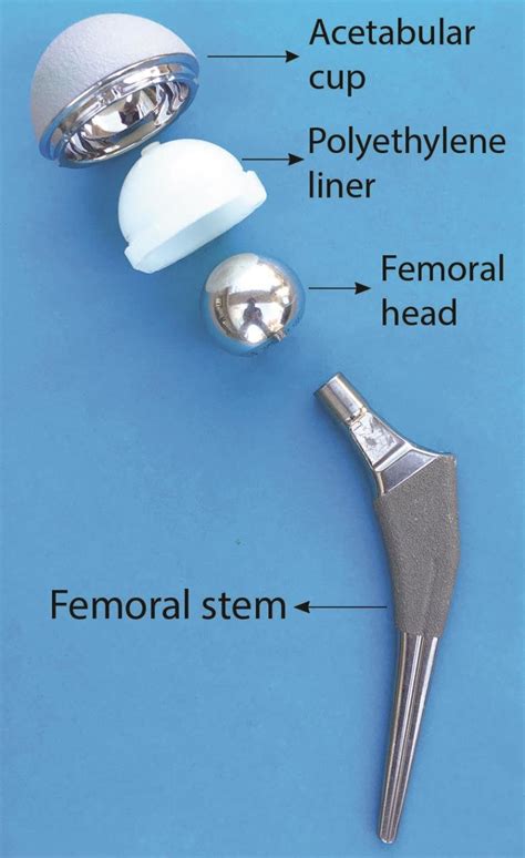 1 Metal on polyethylene total hip replacement. | Download Scientific ...