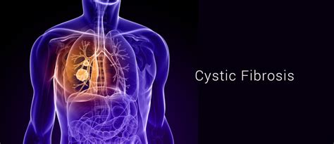 Cystic Fibrosis Screening - High/Low Risk for Chromosomal Abnormalities