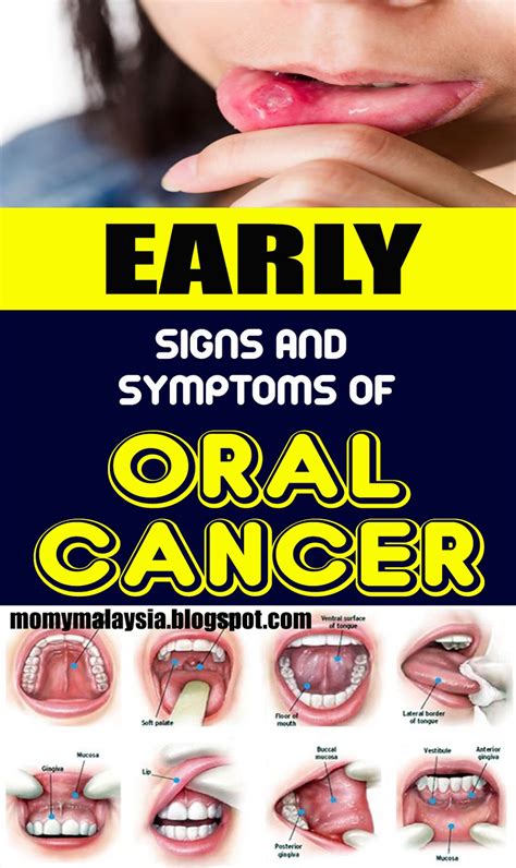 Mouth Cancer Early Warning Signs