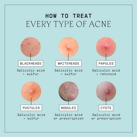 Types of Acne, Explained – Versed Skin