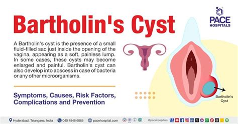 Bartholin Gland Lump