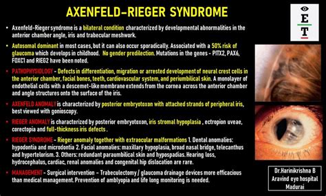 Axenfeld–Rieger Syndrome - EyeToday