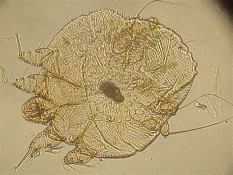 Scabies Bites: Pictures, Symptoms, and Treatments