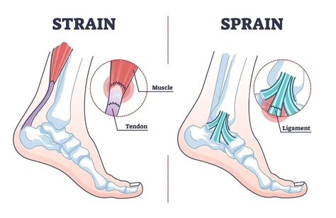 Mri Of Torn Tendon In Left Ankle