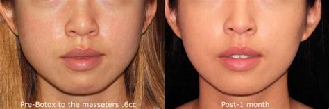 Botox In Jawline Before And After | Pea-vie