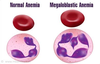 Megaloblastic Anemia - Causes, Symptoms, Signs, Diagnosis, Treatment ...