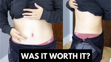 Hernia photos before and after tummy tuck - peryhost