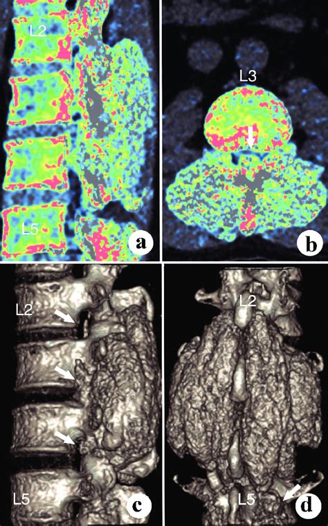 The dual-energy computed tomography shows the dimensions and volume of ...