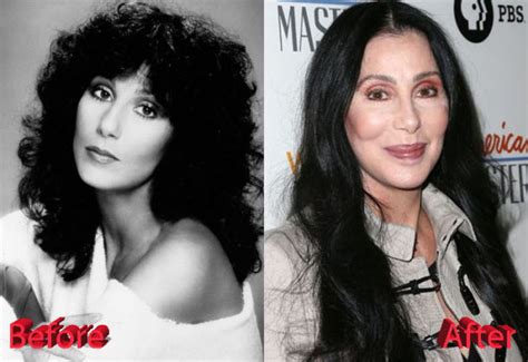 Cher Plastic Surgery : Just Too Much Of Procedures