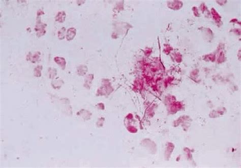 Actinomyces Organisms in Ocular Disease | Ento Key