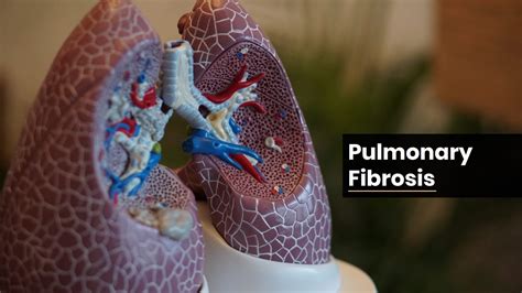 Pulmonary Fibrosis Treatment Ahmedabad