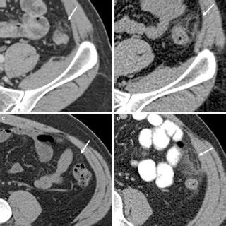 (PDF) Radiology of epiploic appendages: acute appendagitis, post ...