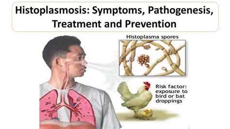 Histoplasmosis: Causes, Symptoms, Diagnosis Treatment, 42% OFF