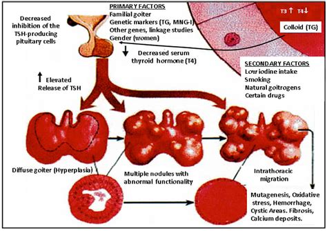 Multinodular Goiter: Risk Factors, Symptoms & Treatments