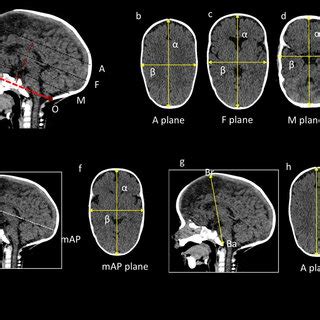 Skull shape severity quantification using traditional cephalic index... | Download Scientific ...