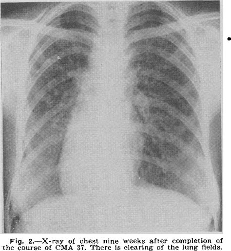 Figure 2 from Treatment of Broncho-Pulmonary Moniliasis with CMA 37 | Semantic Scholar