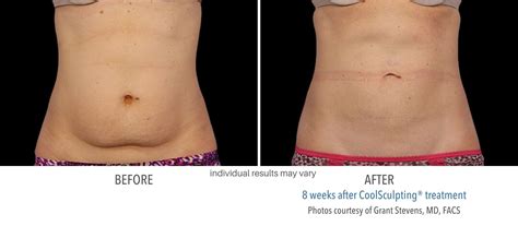 CoolSculpting Before and After | Fat Freezing Body Transformations