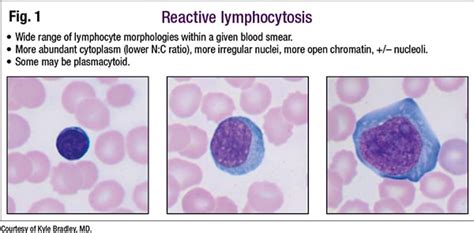 Atypical Lymphocytes Normal Range - MillaService