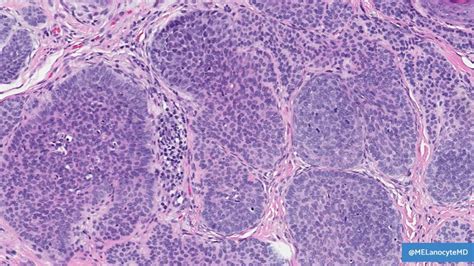 Trichoblastoma: 👩‍⚕️ H&N, slow-growing 👩‍⚕️ Larger, deeper (vs ...