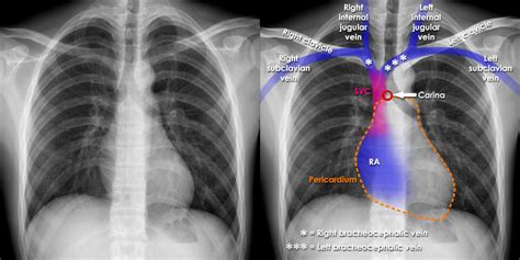 Cvc Chest X Ray