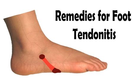 One Of The Best Tips About How To Treat Foot Tendonitis - Sumresort14